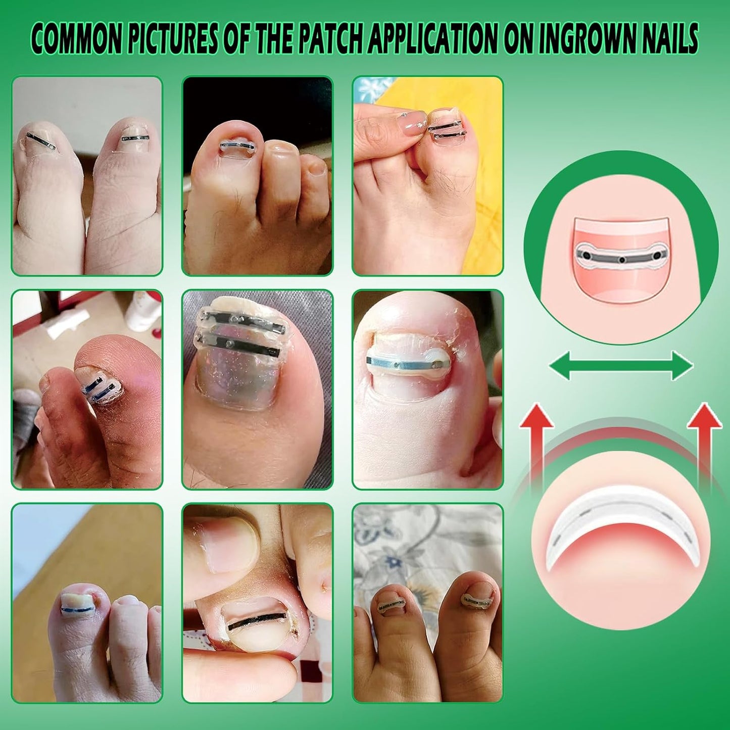 Nail Correction Patch and Retainer Set